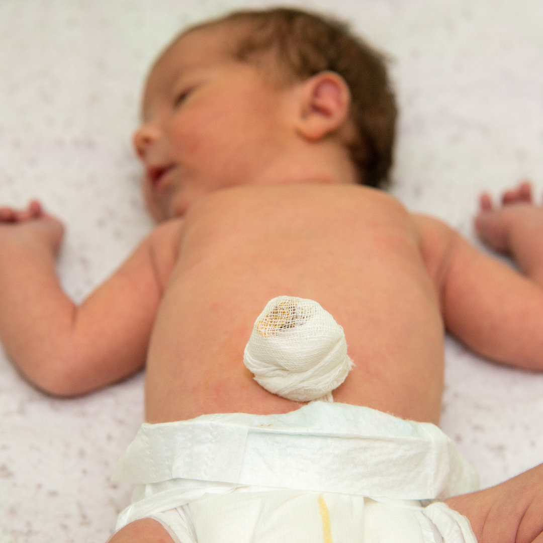 Neugeborenes Baby mit Nabelklemme am Nabelschnurrest.