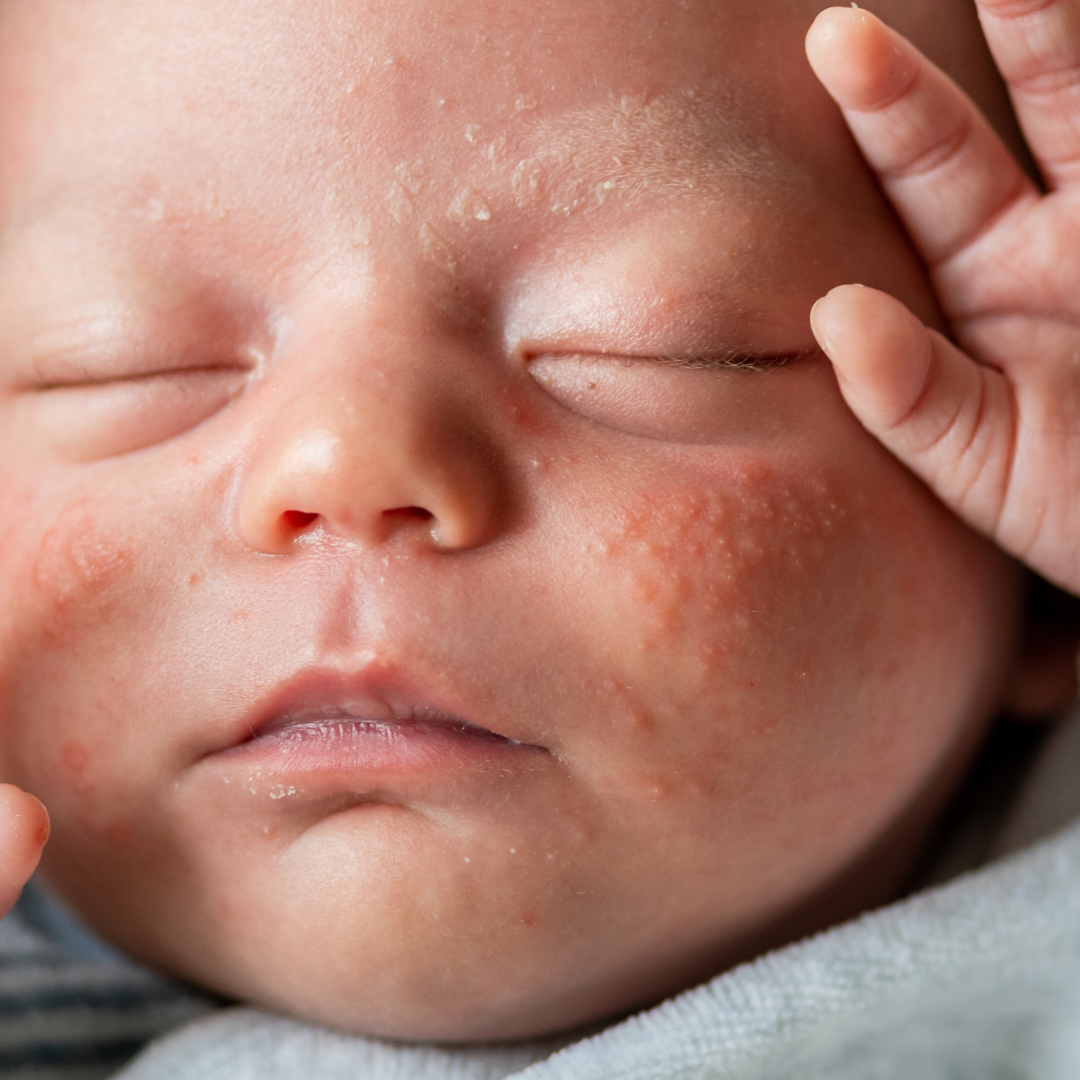 ein neugeborenes Baby mit kleinen Pickelchen im Gesicht, das schläft